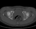 Aneurysmal bone cyst of ischium (Radiopaedia 25957-26094 Axial bone window 58).png