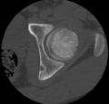 Aneurysmal bone cyst of ischium (Radiopaedia 25957-26094 B 11).png
