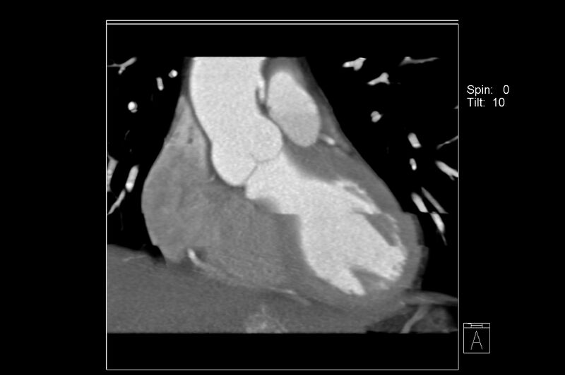 File:Anomalous right coronary artery (ARCA) with interarterial course (Radiopaedia 12423-12677 C 2).jpg