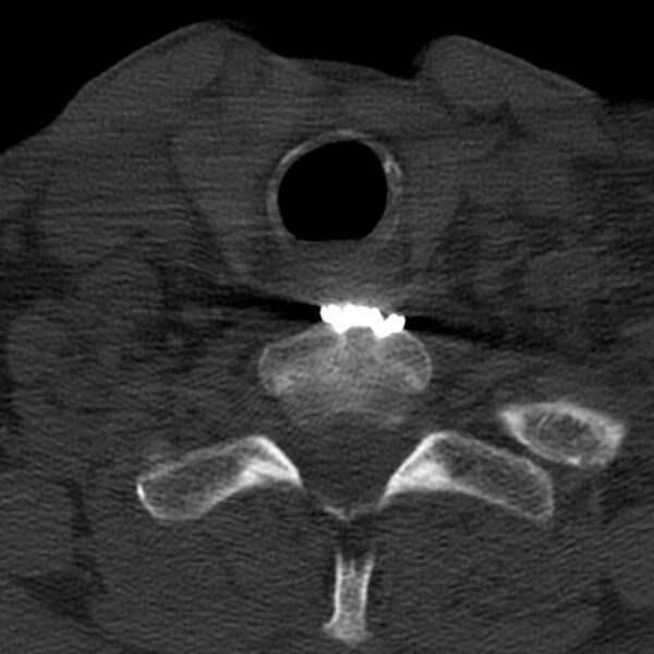 File:Anterior cervical postdiscectomy arthrodesis (Radiopaedia 32678-33646 Axial bone window 63).jpg