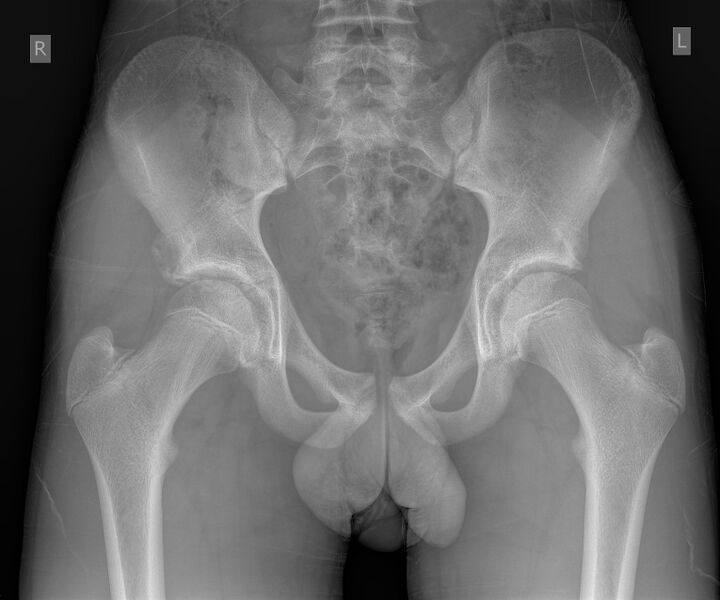 File:Anterior inferior iliac spine avulsion fracture - subacute (Radiopaedia 63151-71671 Frontal 1).jpg