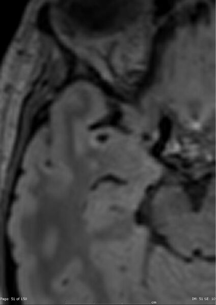 File:Anterior temporal lobe perivascular space (Radiopaedia 40946-43650 C 12).jpg