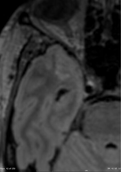 File:Anterior temporal lobe perivascular space (Radiopaedia 40946-43650 C 3).jpg