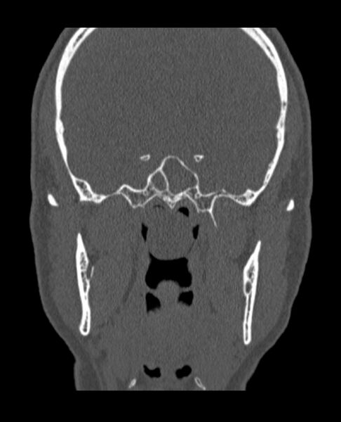 File:Antrochoanal polyp (Radiopaedia 79011-92169 Coronal bone window 17).jpg