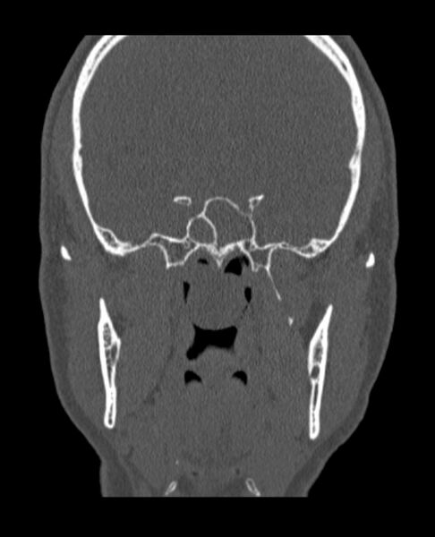 File:Antrochoanal polyp (Radiopaedia 79011-92169 Coronal bone window 19).jpg