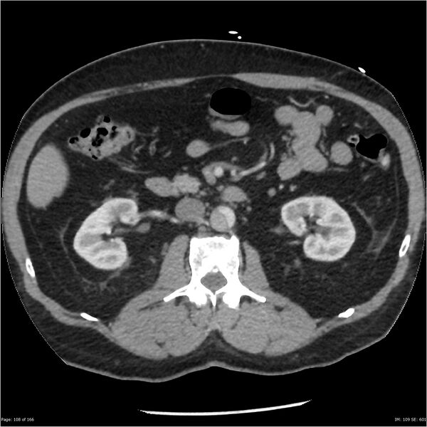 File:Aortic dissection- Stanford A (Radiopaedia 37759-39664 A 99).jpg
