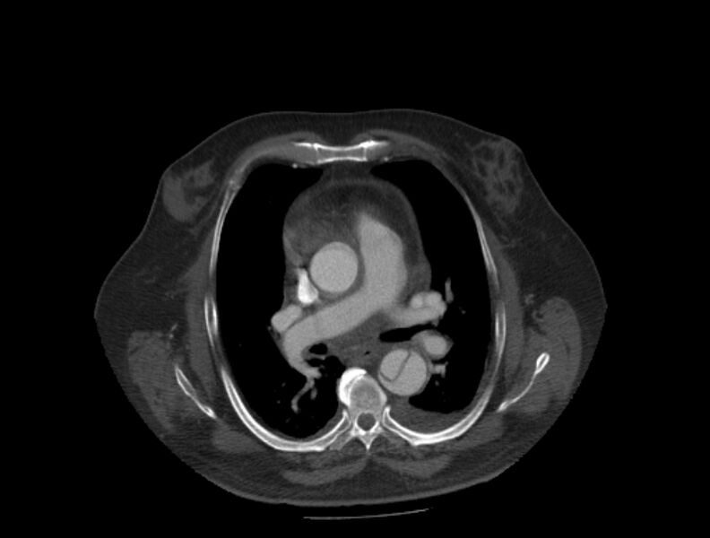 File:Aortic dissection (Radiopaedia 28802-29105 A 17).jpg