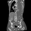 Aortic dissection (Radiopaedia 68763-78691 B 25).jpeg