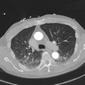 Aortic dissection - DeBakey type II (Radiopaedia 64302-73082 Axial lung window 23).png