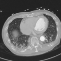 Aortic dissection - DeBakey type II (Radiopaedia 64302-73082 Axial lung window 45).png