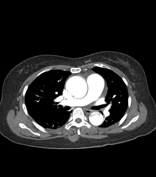 File:Aortic dissection with renal ischemia (Radiopaedia 76573-88338 A 28).jpg