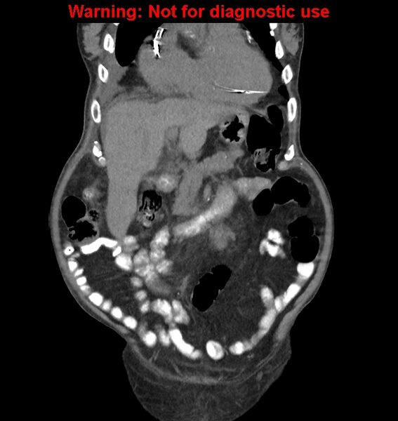File:Aortic graft infection (Radiopaedia 44979-48907 non-contrast 15).jpg