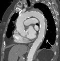 Aortic intramural hematoma (Radiopaedia 35987).jpg