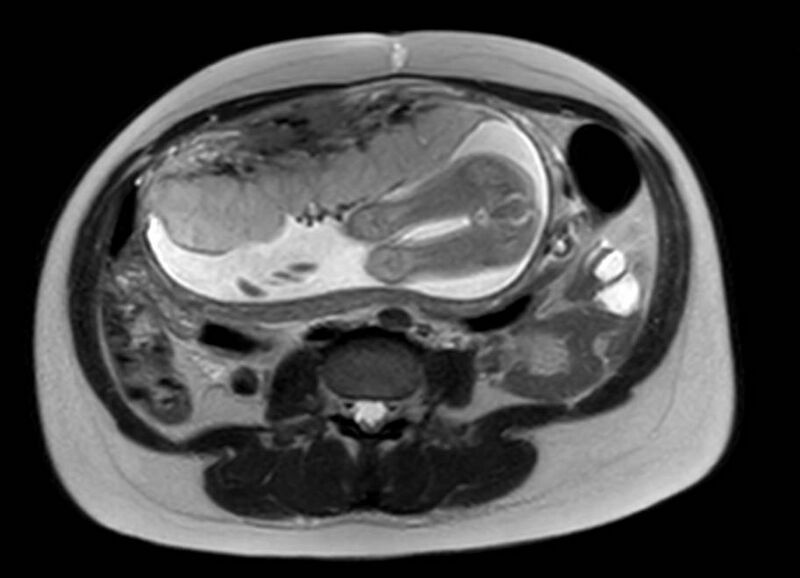 File:Appendicitis in gravida (MRI) (Radiopaedia 89433-106395 Axial T2 36).jpg