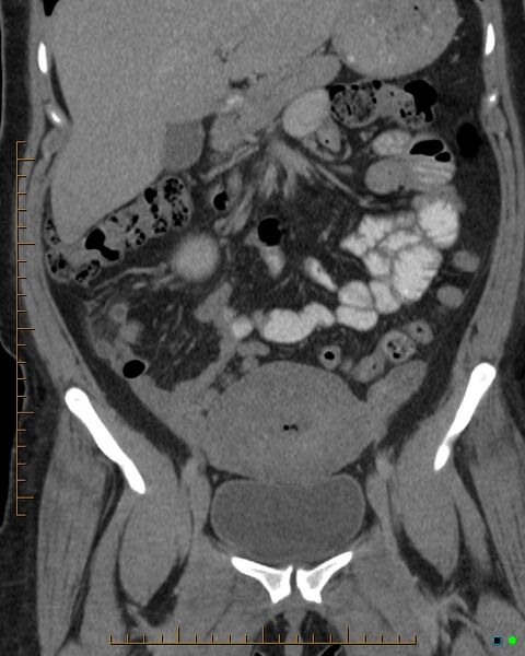 File:Appendicitis post recent cesarian section (Radiopaedia 29594-30102 D 8).jpg