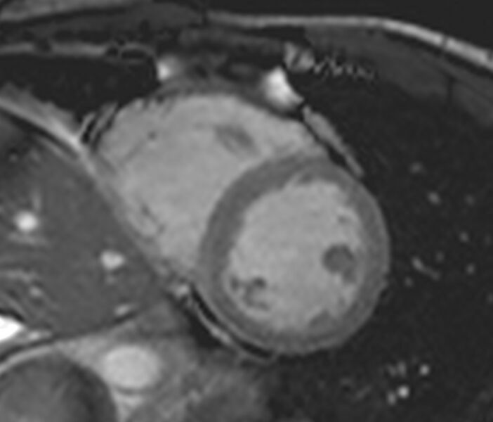 File:Arrhythmogenic right ventricular cardiomyopathy (Radiopaedia 39806-42237 F 3).jpg