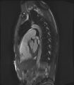 Arrhythmogenic right ventricular cardiomyopathy (Radiopaedia 57972-64966 Cine RVOT SSFP 15).jpg