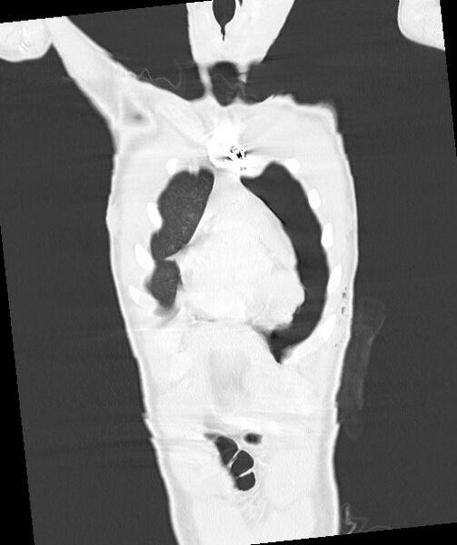 File:Arrow injury to the chest (Radiopaedia 85367-100975 Coronal lung window 44).jpg