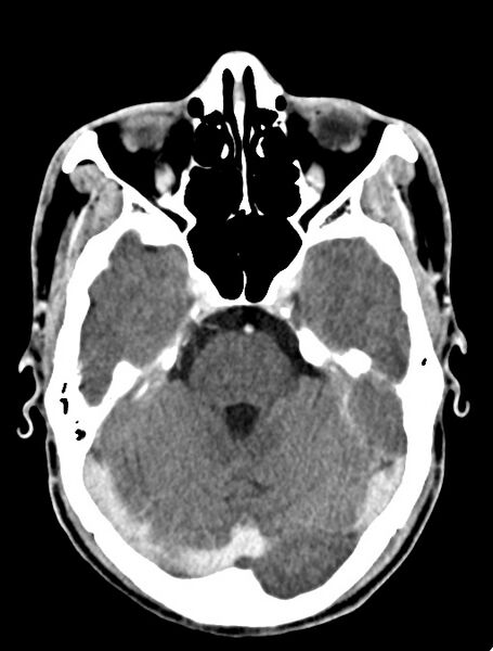 File:Arrow injury to the face (Radiopaedia 73267-84011 Axial C+ delayed 43).jpg