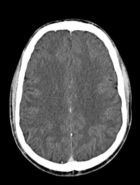 File:Arrow injury to the face (Radiopaedia 73267-84011 Axial C+ delayed 62).jpg