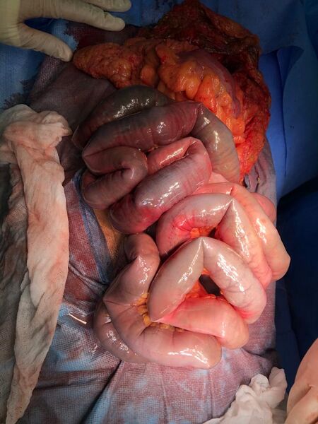 File:Arterial occlusive mesenteric ischemia (Radiopaedia 84641-100061 Intra-operative 1).jpg