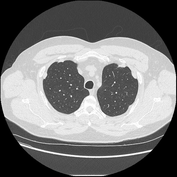 File:Asbestosis (Radiopaedia 45002-48961 Axial lung window 11).jpg
