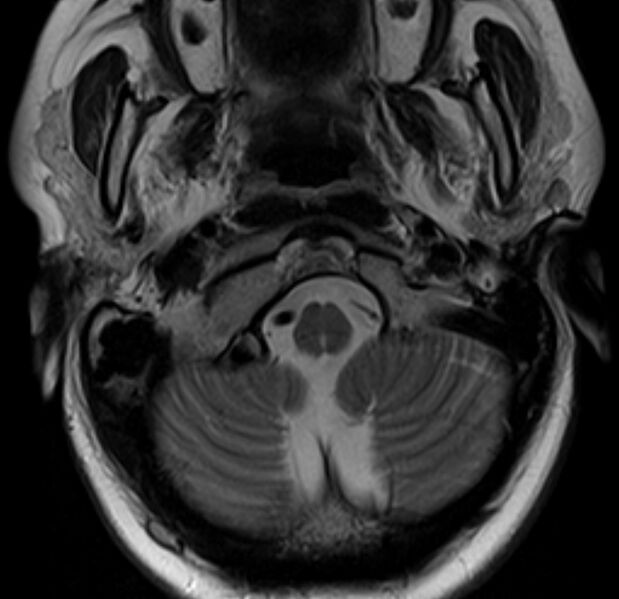 File:Astrocytoma - spinal cord (Radiopaedia 69769-79758 Axial T2 3).jpg