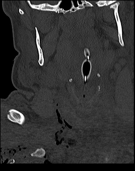 File:Atlanto-occipital dissociation - Traynelis type 1 (Radiopaedia 87570-103948 Coronal bone window 14).jpg
