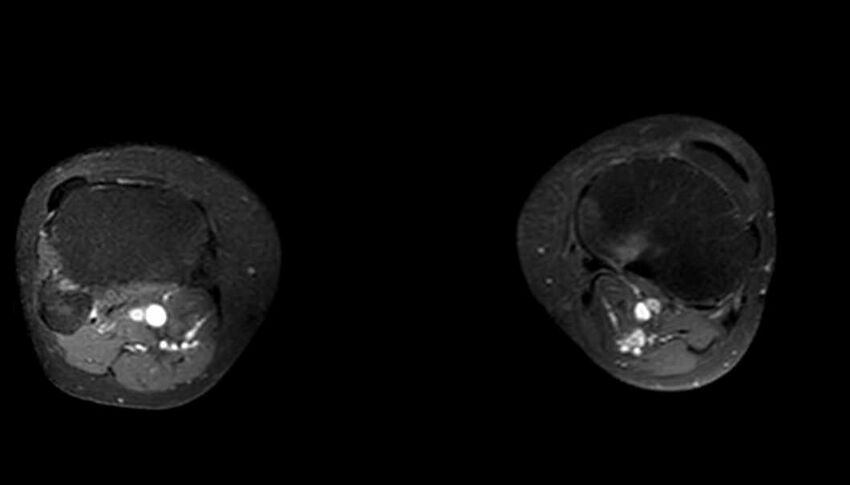 Atypical lipomatous tumor - thigh (Radiopaedia 68975-78734 Axial T1 C+ fat sat 1).jpg