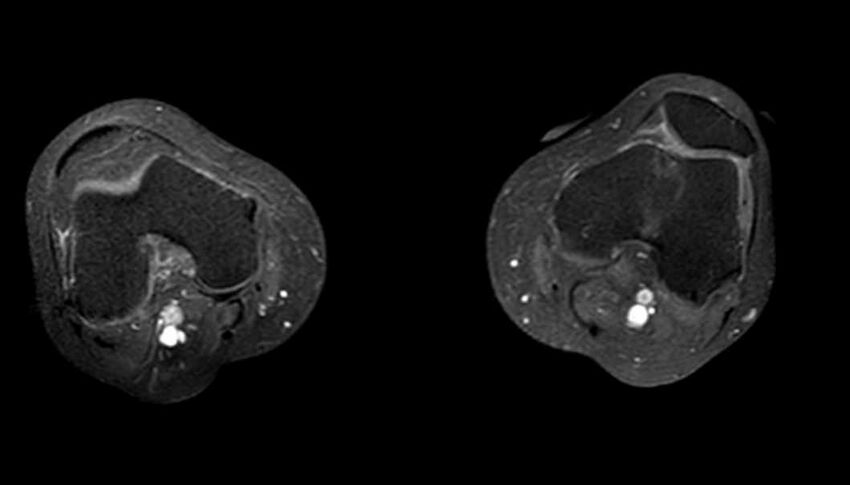 Atypical lipomatous tumor - thigh (Radiopaedia 68975-78734 Axial T1 C+ fat sat 10).jpg