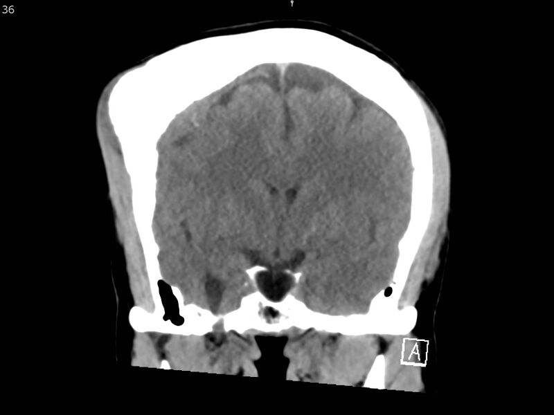 File:Atypical meningioma - intraosseous (Radiopaedia 64915-73867 B 35).jpg