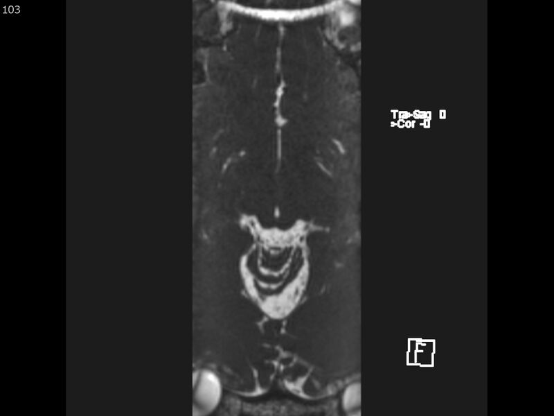 File:Atypical meningioma - intraosseous (Radiopaedia 64915-74572 Axial CISS 103).jpg