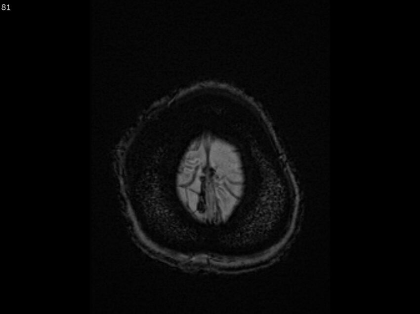 Atypical meningioma - intraosseous (Radiopaedia 64915-74572 Axial SWI 81).jpg