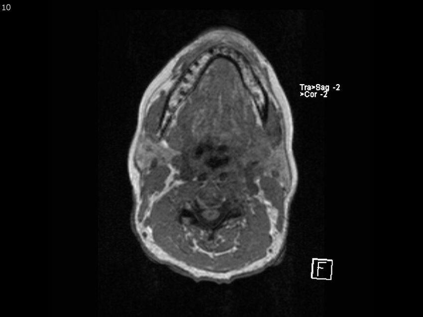 Atypical meningioma - intraosseous (Radiopaedia 64915-74572 Axial T1 10).jpg