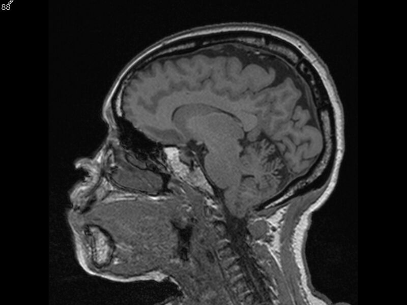 File:Atypical meningioma - intraosseous (Radiopaedia 64915-74572 Sagittal T1 88).jpg