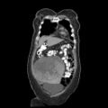Atypical retroperitoneal lymphocoeles with large leiomyoma of uterus (Radiopaedia 32084-33024 B 3).jpg