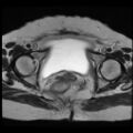Atypical retroperitoneal lymphocoeles with large leiomyoma of uterus (Radiopaedia 32084-33027 Axial T2 26).jpg