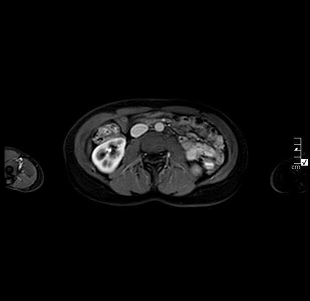 File:Autoimmune pancreatitis (Radiopaedia 40166-42675 Axial arterial phase 13).JPG