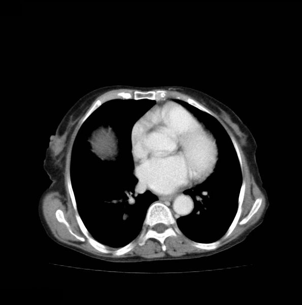 File:Autosomal dominant polycystic kidney disease (Radiopaedia 16777-16490 A 2).jpg