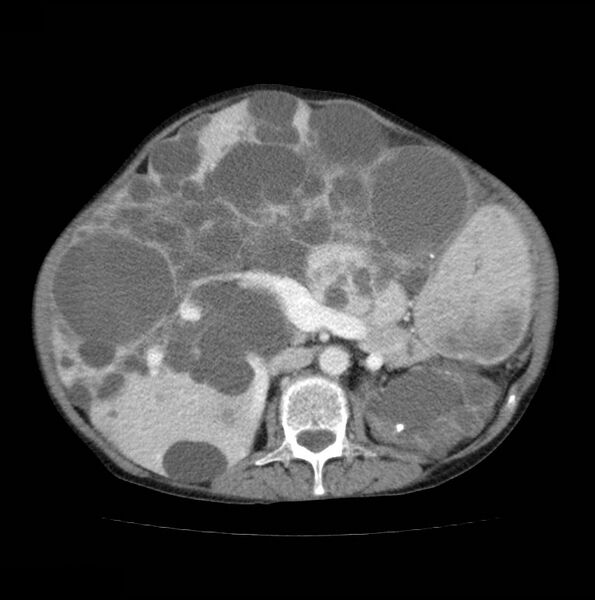 File:Autosomal dominant polycystic kidney disease (Radiopaedia 16777-16490 A 25).jpg