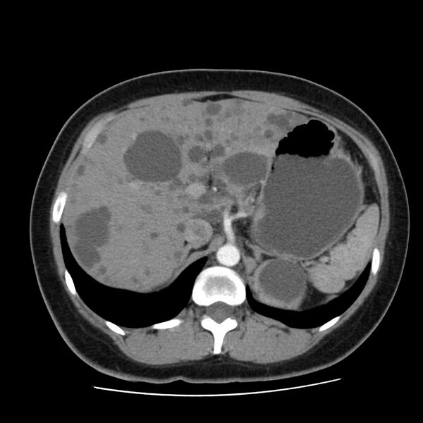 File:Autosomal dominant polycystic kidney disease (Radiopaedia 23061-23093 B 18).jpg