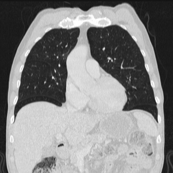 File:Azygos lobe (Radiopaedia 38259-40275 Coronal lung window 29).jpg