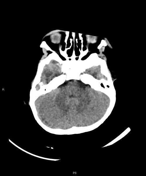 File:Basal ganglia and parenchymal ischemia (Radiopaedia 45818-50083 Axial non-contrast 34).jpg