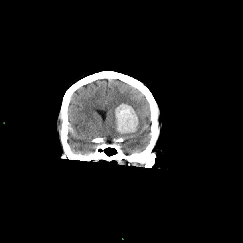 Basal ganglia hemorrhage (Radiopaedia 58349-65472 Coronal non-contrast 42).jpg