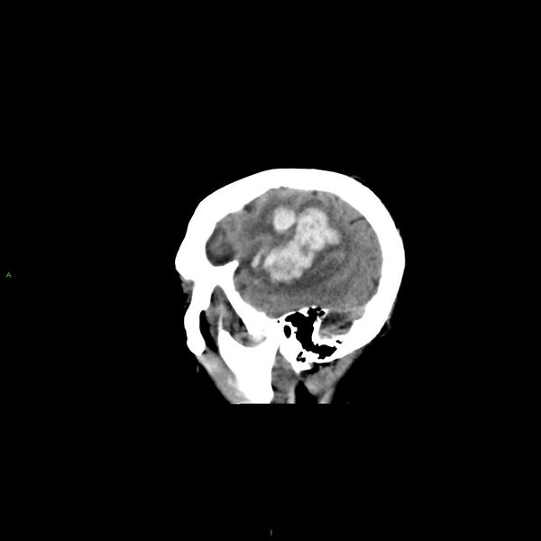 File:Basal ganglia hemorrhage (Radiopaedia 58350-65473 C 10).jpg