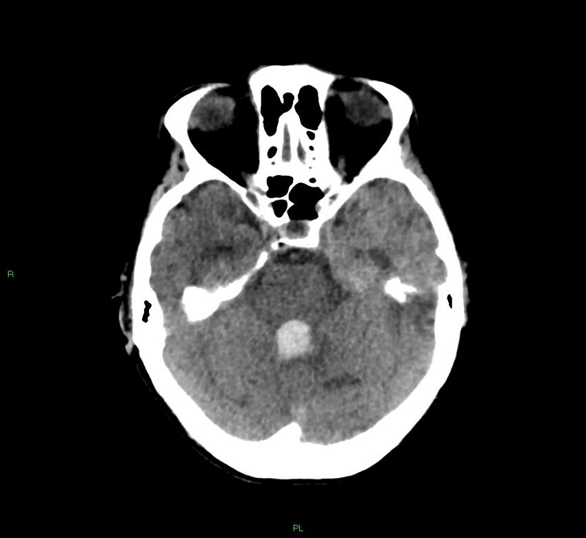Basal ganglia hemorrhage (Radiopaedia 58766-65988 Axial non-contrast 40).jpg