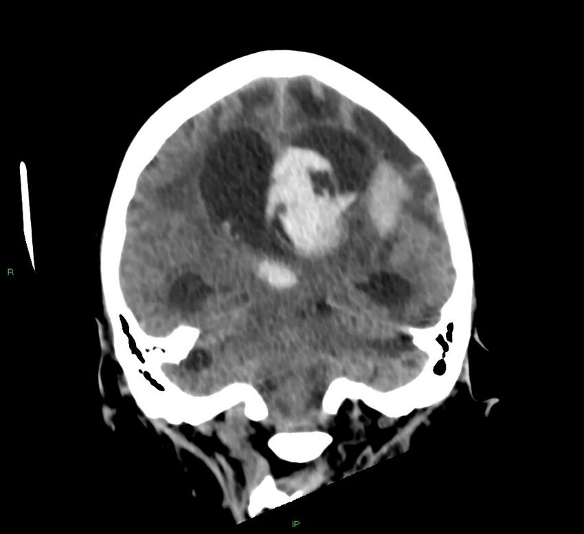 Basal ganglia hemorrhage (Radiopaedia 58766-65988 Coronal non-contrast 31).jpg