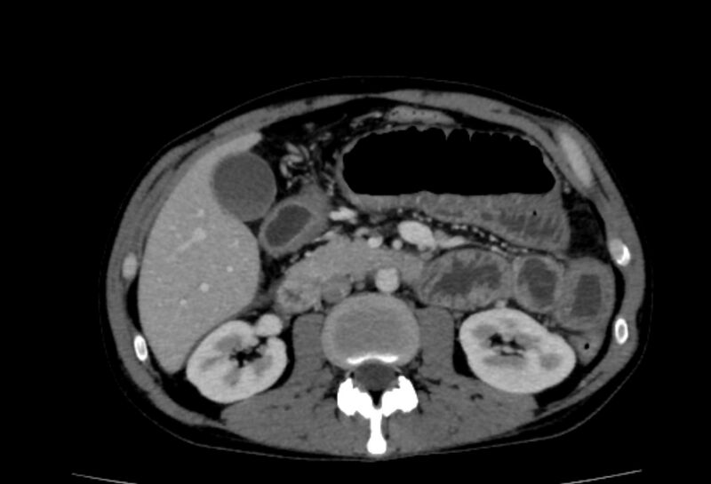 File:Behçet's disease- abdominal vasculitis (Radiopaedia 55955-62570 A 33).jpg