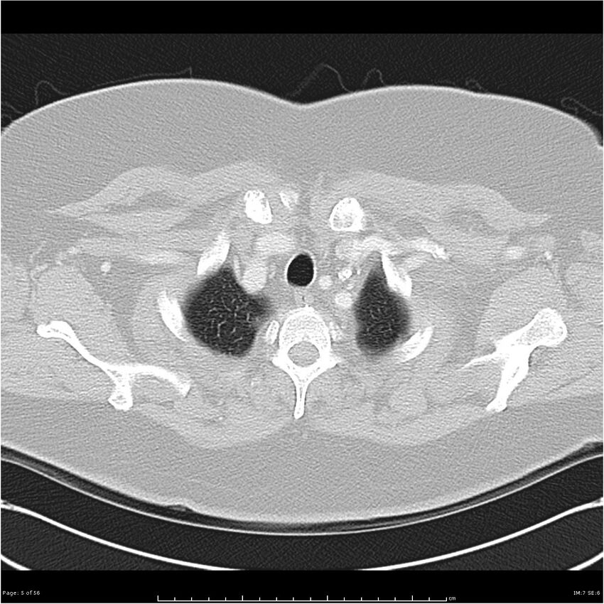Benign metastasizing leiomyoma (Radiopaedia 26803-26962 Axial lung window 5).jpg