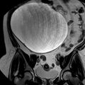 Benign seromucinous cystadenoma of the ovary (Radiopaedia 71065-81300 F 14).jpg